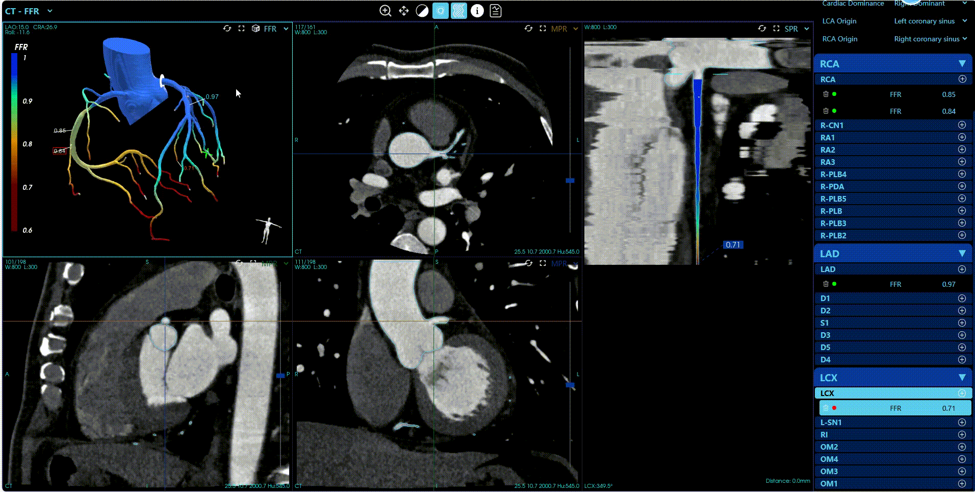 CT-Suite™ Myocardial Functionality