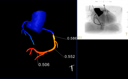 The diagnostic tools of coronary artery disease have been changed from invasive to noninvasive by products developed by Escope Tech in China